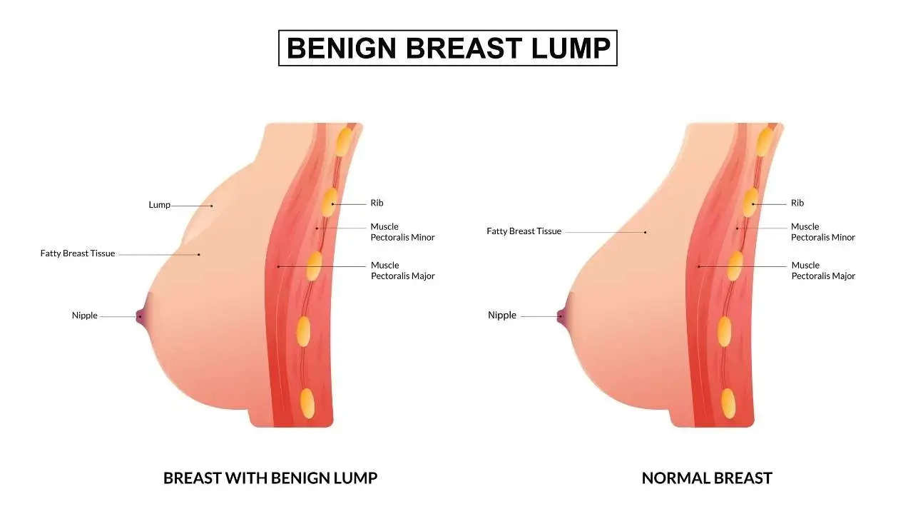 A Lump in Your Breast? What It Means