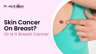 Skin cancer on breast ?  Or is it breast cancer - Dr Jay Anam