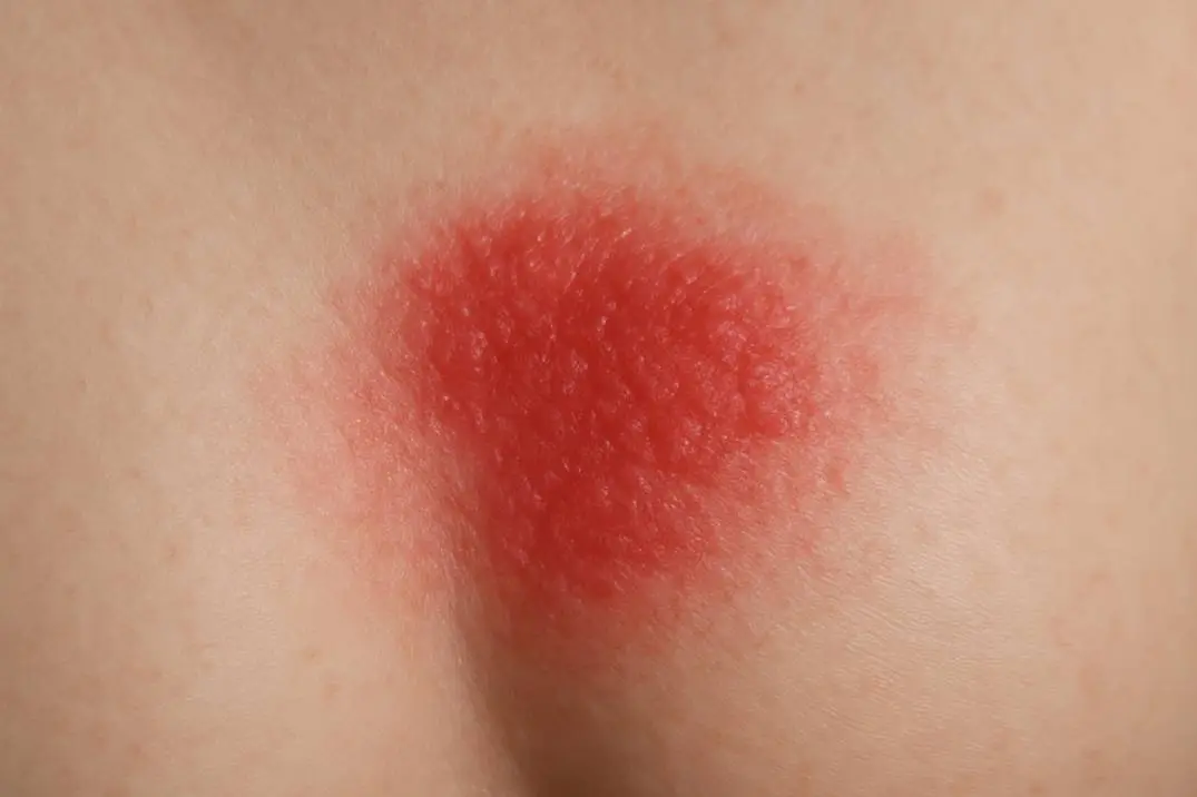 Inflammatory Breast Cancer Rash